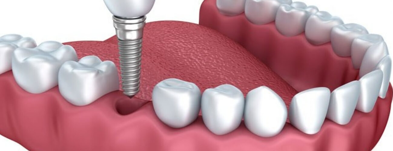 küçükçekmece implant, küçükçekmece diş beyazlatma, küçükçekmece şeffaf plak, küçükçekmece ortodonti, küçükçekmece diş hekimi, küçükçekmece diş kliniği, sefaköy diş hekimi, sefaköy diş kliniği, küçükçekmece ortodonti doktoru, sefaköy ortodonti doktoru, sefaköy implant tedavisi, küçükçekmece implant tedavisi, implant tedavisi, mekanik diş