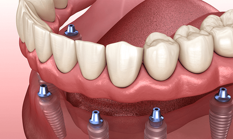 all-on-6-dental-implants-in-turkey