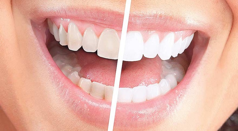 dis_beyazlatma_tedavisi dis_beyazlatma_tedavisi, küçükçekmece implant, küçükçekmece diş beyazlatma, küçükçekmece şeffaf plak, küçükçekmece ortodonti, küçükçekmece diş hekimi, küçükçekmece diş kliniği, sefaköy diş hekimi, sefaköy diş kliniği, küçükçekmece ortodonti doktoru, sefaköy ortodonti doktoru
