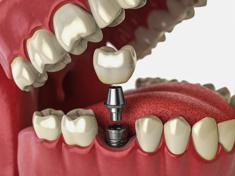 Sefaköy İmplant İşlemi sefaköy_implant_işlemi, küçükçekmece implant, küçükçekmece diş beyazlatma, küçükçekmece şeffaf plak, küçükçekmece ortodonti, küçükçekmece diş hekimi, küçükçekmece diş kliniği, sefaköy diş hekimi, sefaköy diş kliniği, küçükçekmece ortodonti doktoru, sefaköy ortodonti doktoru