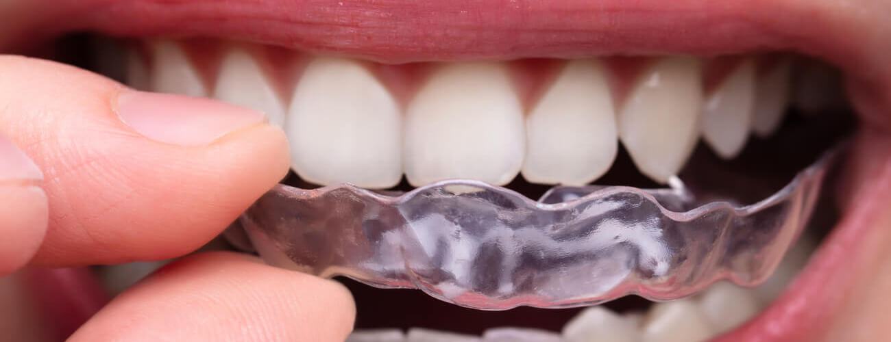 küçükçekmece implant, küçükçekmece diş beyazlatma, küçükçekmece şeffaf plak, küçükçekmece ortodonti, küçükçekmece diş hekimi, küçükçekmece diş kliniği, sefaköy diş hekimi, sefaköy diş kliniği, küçükçekmece ortodonti doktoru, sefaköy ortodonti doktoru, sefaköy şeffaf plak, sefaköy seffaf plak, kucukcekmece seffaf plak, küçükçekmece şeffaf plak, şeffaf plak