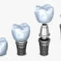Dental İmplantlar Kimlere Uygulanabilir?