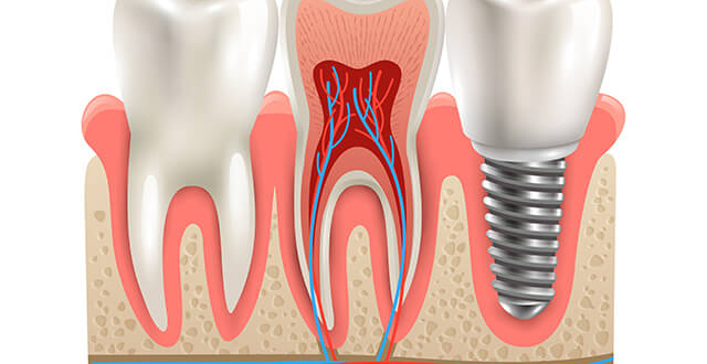 İmplant Tedavisi Sefaköy Küçükçekmece, sefaköy implant, küçükçekmece implant