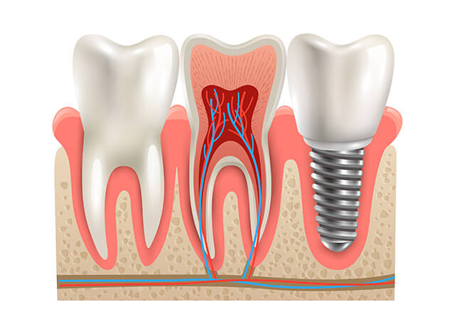 İmplant Tedavisi Sefaköy Küçükçekmece, sefaköy implant, küçükçekmece implant