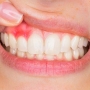 Agresif Periodontitis Nedir?