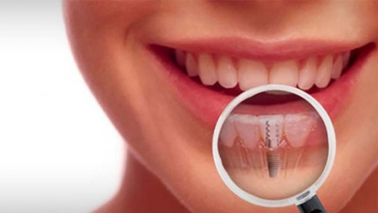 Diş İmplantının Avantajları Nelerdir?