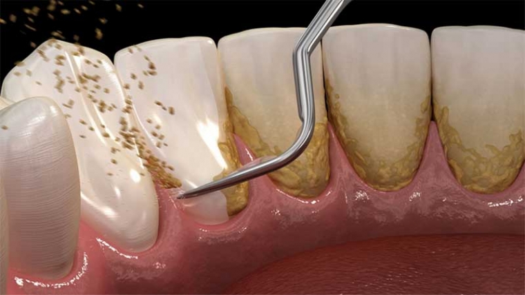 Diş Tartarları Neden Oluşur?