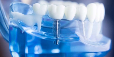 İmplant Diş Tedavisi Ne Kadar Sürede Biter