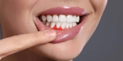 Diş apsesi nedir nasıl geçer?
