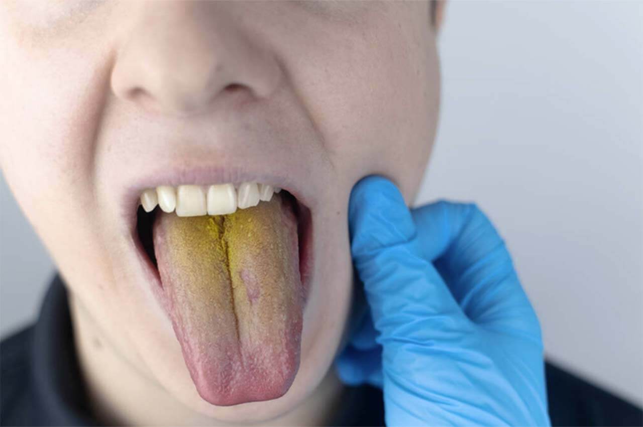 Dil Sararması Hangi Hastalığın Belirtisidir?