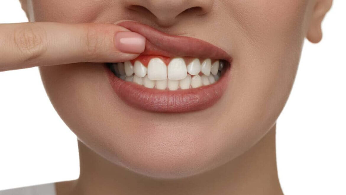 Agresif Periodontitis Tedavisi
