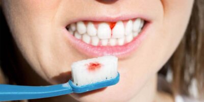 Diş Eti Kanaması, Nedenleri ve Tedavisi