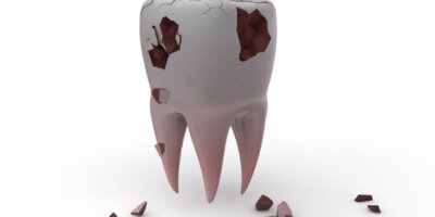 Kırık Diş Tedavisi, Kırık diş tedavisi nasıl yapılır? Ön ve Arkada kırık diş tedavisi